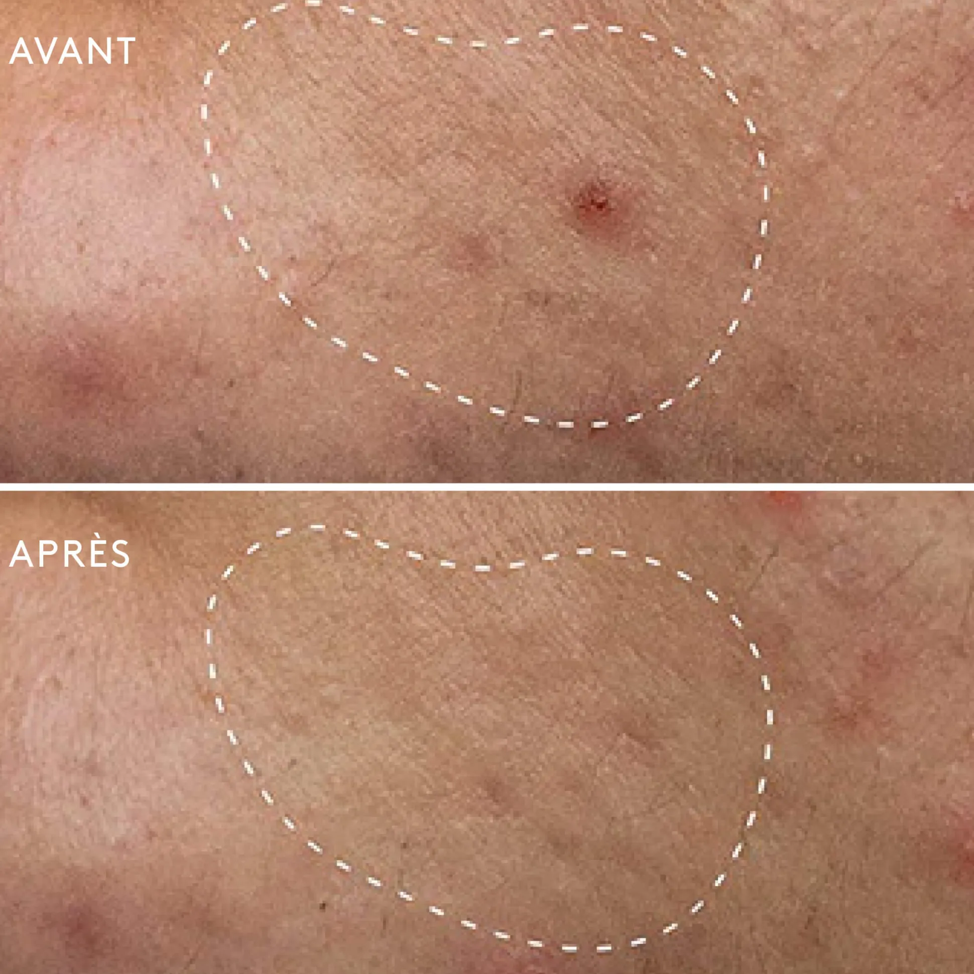 Deep Breakout Liquid Patch Anti-Imperfections