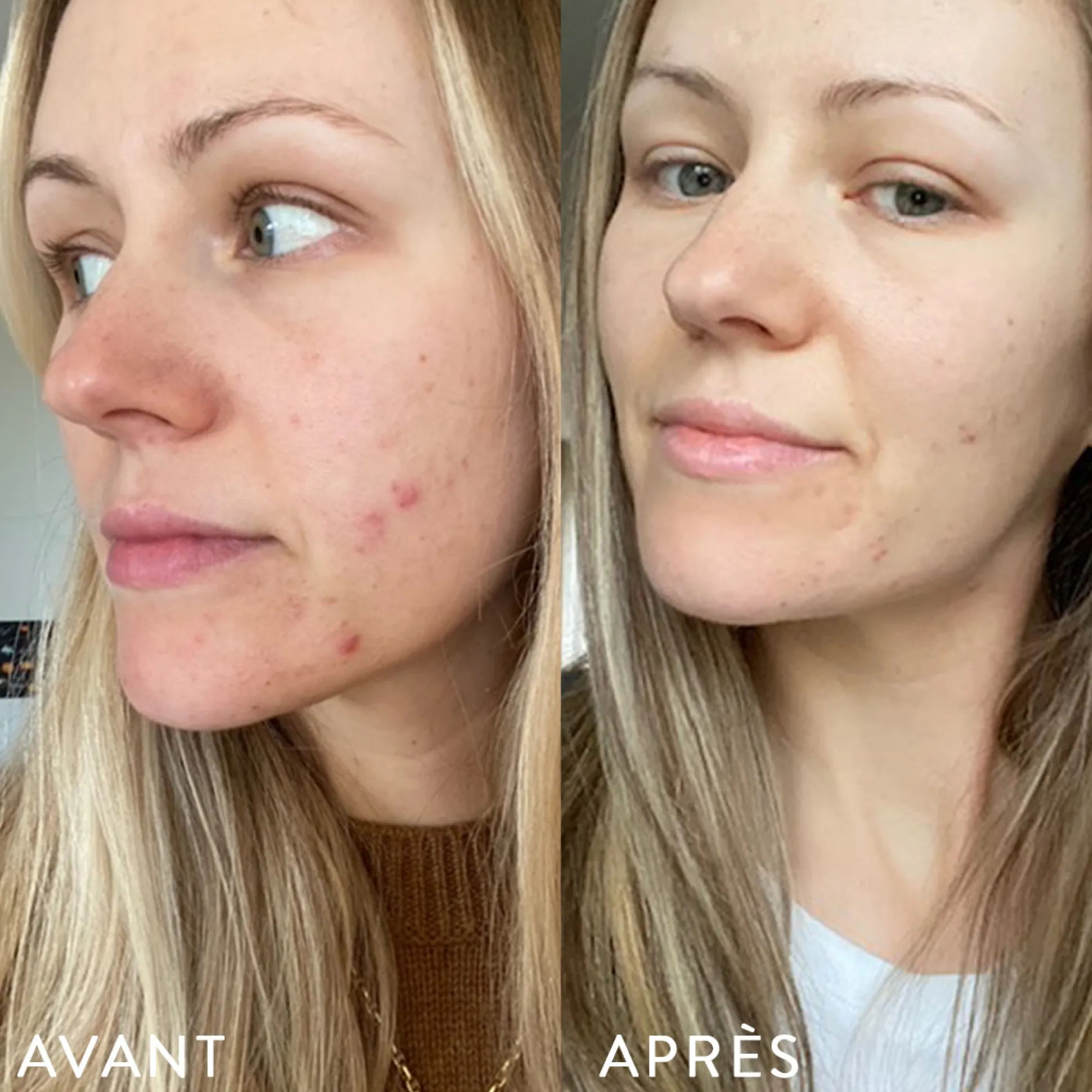 Microbiote & Peau